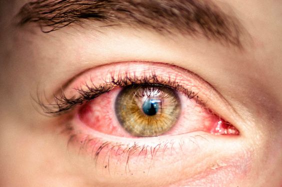 Eyes After Smoking Weed?! | Blog | Green